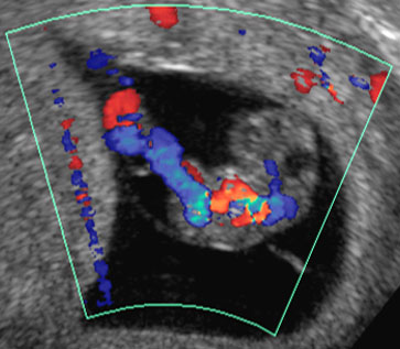 VÃ­deoBlog - Ultrassonografia MorfolÃ³gica Do Primeiro Trimestre - O PerÃ­odo EmbrionÃ¡rio