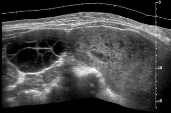 Ultrassonografia da DoenÃ§a TrofoblÃ¡stica Gestacional