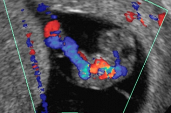 Ultrassonografia MorfolÃ³gica do Primeiro Trimestre da Gravidez. O PerÃ­odo EmbrionÃ¡rio