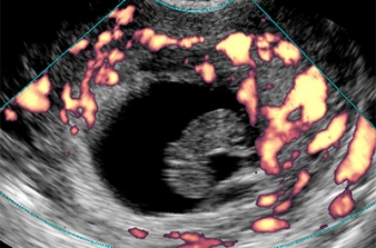 Ultrassonografia no Abortamento