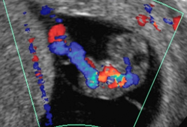 VÃ­deoBlog - Ultrassonografia MorfolÃ³gica Do Primeiro Trimestre - O PerÃ­odo EmbrionÃ¡rio